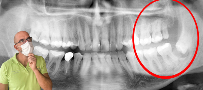 [Video] COME LO TOGLIAMO ‘STO OTTAVO NEL RAMO MANDIBOLARE?