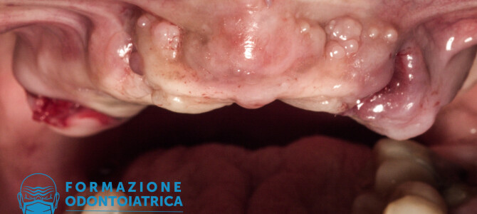 [VIDEO] Lo scollamento del lembo nel full arch superiore. Un caso complesso.