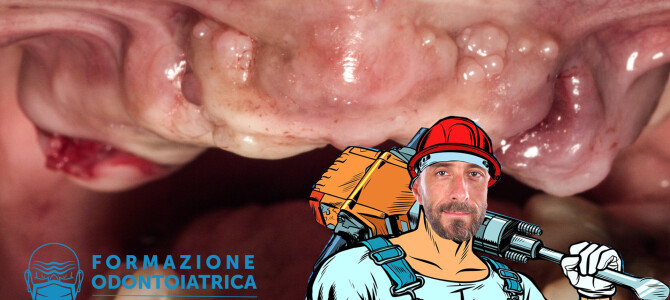 [Video] Come eseguire (in fretta) una copiosa osteotomia in un caso di all-on-4