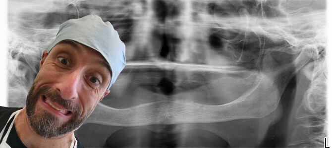 ISOLAMENTO E PROTEZIONE DEL NERVO MENTONIERO SUPERFICIALIZZATO NEL FULL-ARCH INFERIORE. UN VIDEO AL SUPERSUCCHIO!