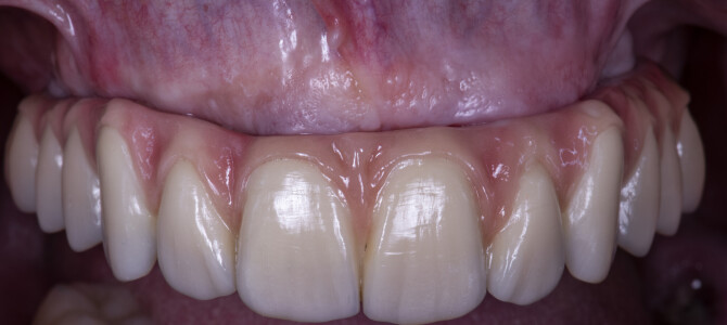 PERCHÈ UNA “TORONTO” (FATTA BENE) È PIÙ PULIBILE DI UN PONTE SU IMPIANTI TUTTO BIANCO PERCHÈ UNA “TORONTO” (FATTA BENE) È PIÙ PULIBILE DI UN PONTE SU IMPIANTI TUTTO BIANCO