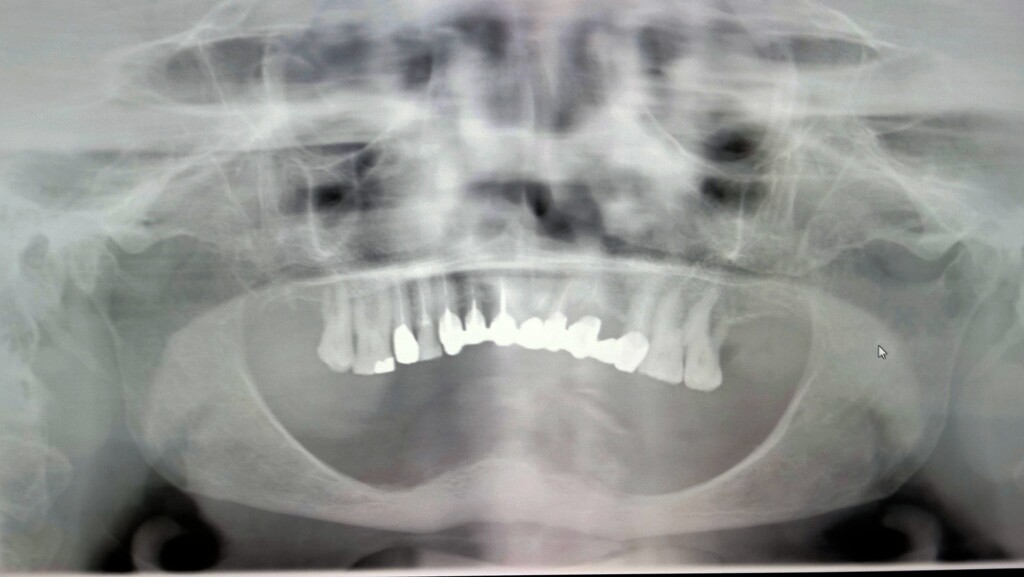 Mandibola atrofica Formazione Odontoiatrica