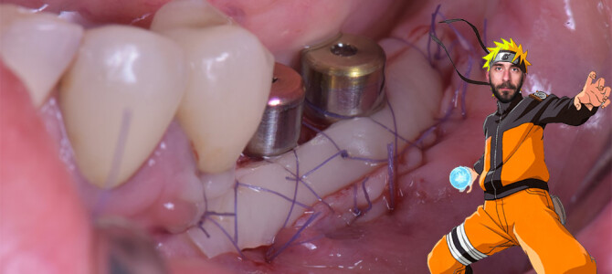 [video] Tecnica dell’innesto gengivale libero in mandibola posteriore. Capitolo 3: Sutura dell’innesto.