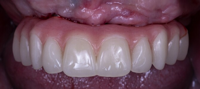 Beccati il video!! Ho fatto anch’io una riabilitazione full-arch guidata…