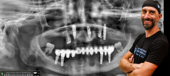 [VIDEO] UN CASO DIFFICILE SU UN PAZIENTE DIFFICILE CON UNA COMPLICAZIONE INTRAOPERATORIA DA GESTIRE. NON TUTTE LE MATTINE FILANO VIA SERENE…