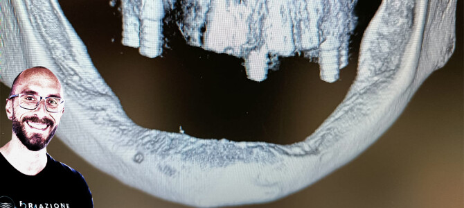 [video] RICORDERAI QUESTO CASO… OGGI TI MOSTRO L’ISOLAMENTO DEL MENTONIERO DI SINISTRA