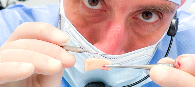 [VIDEO]GESTIONE DEL TAGLIO DI SCARICO IN MANDIBOLA POSTERIORE PER PRELIEVO OSSEO