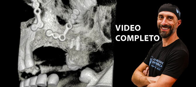 [VIDEO] UN CASO DI RIGENERAZIONE OSSEA CON UNA PICCOLA COMPLICAZIONE