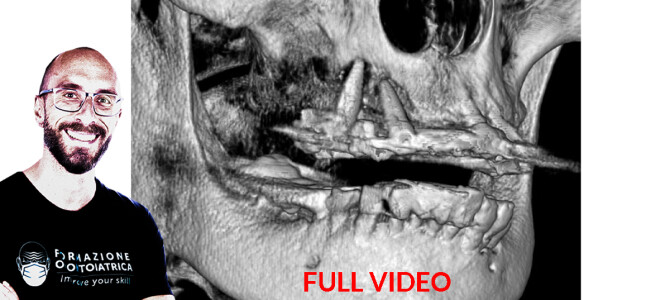 [VIDEO]QUANTO OSSO CRESTALE SERVE PER METTERE UN IMPIANTO TRANSINUSALE?