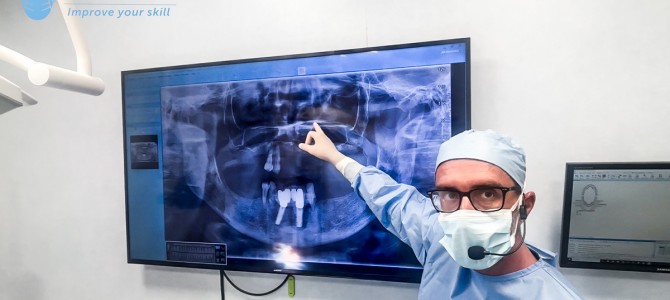 [VIDEO] CASO STANDARD DI IMPIANTI TRANSINUSALI. IL MIGLIOR VIDEO AL MONDO…