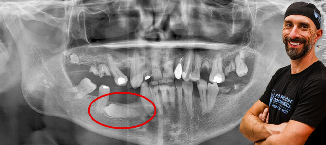 [VIDEO] Estrazione di un premolare distoverso incluso in mandibola